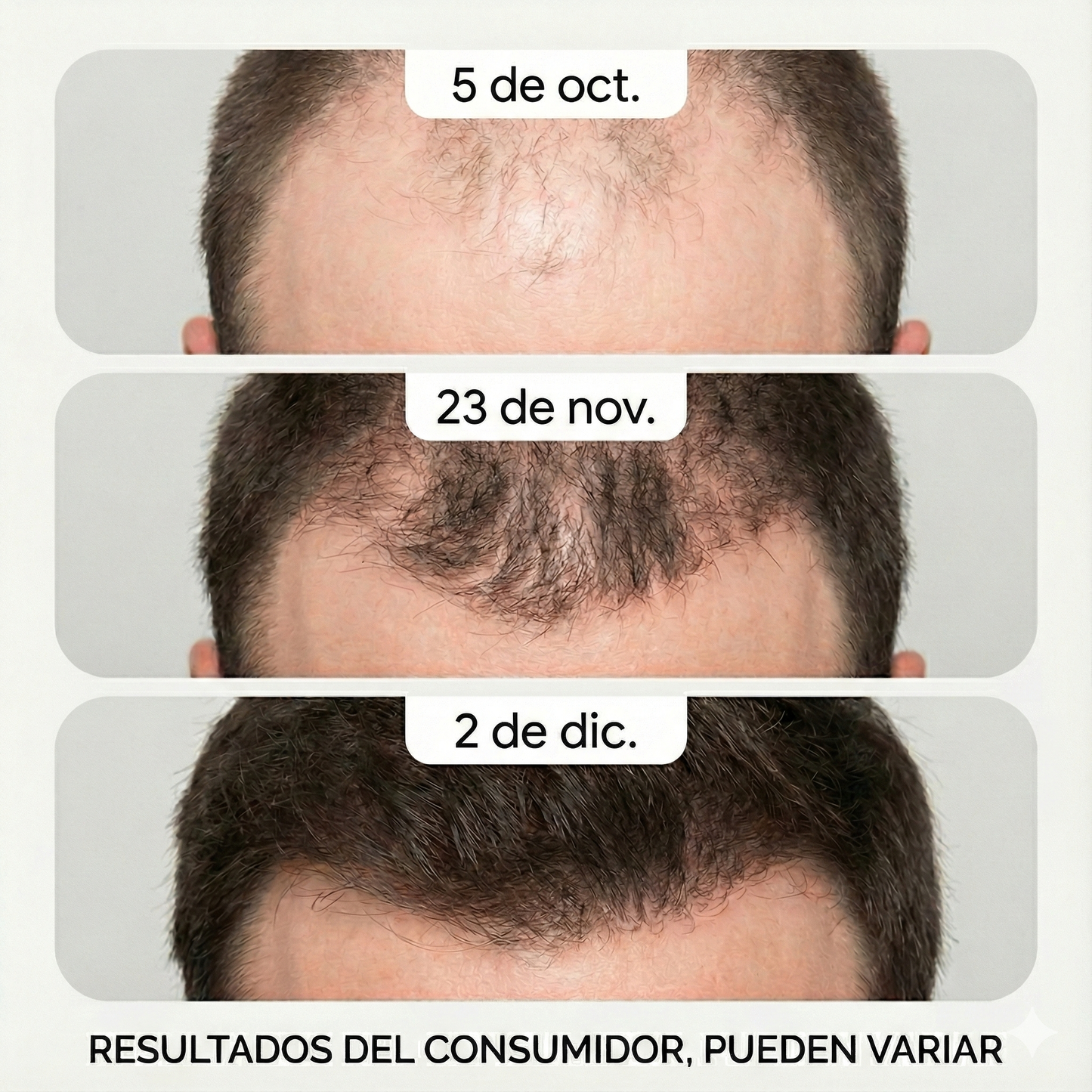 Combo Anti-Caida Definitivo: Minoxidil 5% con Tretinoína + Dermaroller